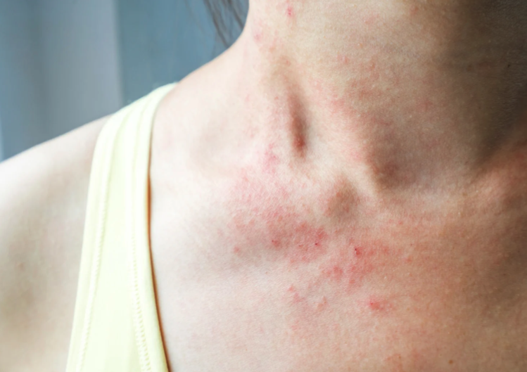 Dermatitis Kontak Alergi